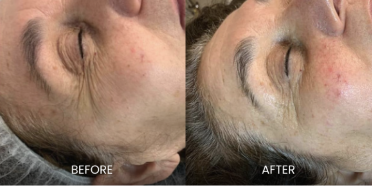 Wrinkles Microneedling